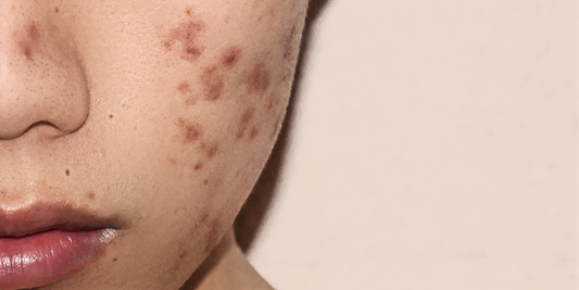Reveal Radiant Teen Skin with Our Latest Special: The Teen Facial!