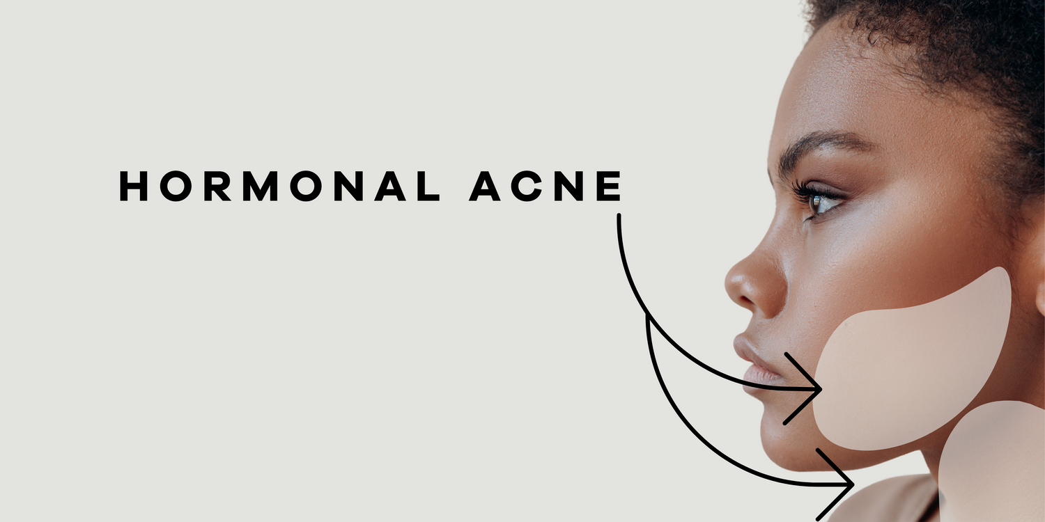 Say Goodbye to Hormonal Acne: Unveiling the Secrets of Clear Skin