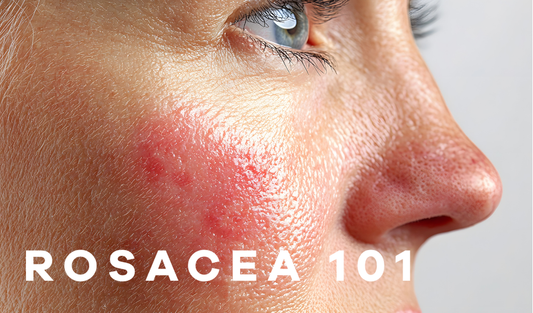 The Complete Guide to Rosacea: Triggers, Root Causes, and Best Skincare Solutions